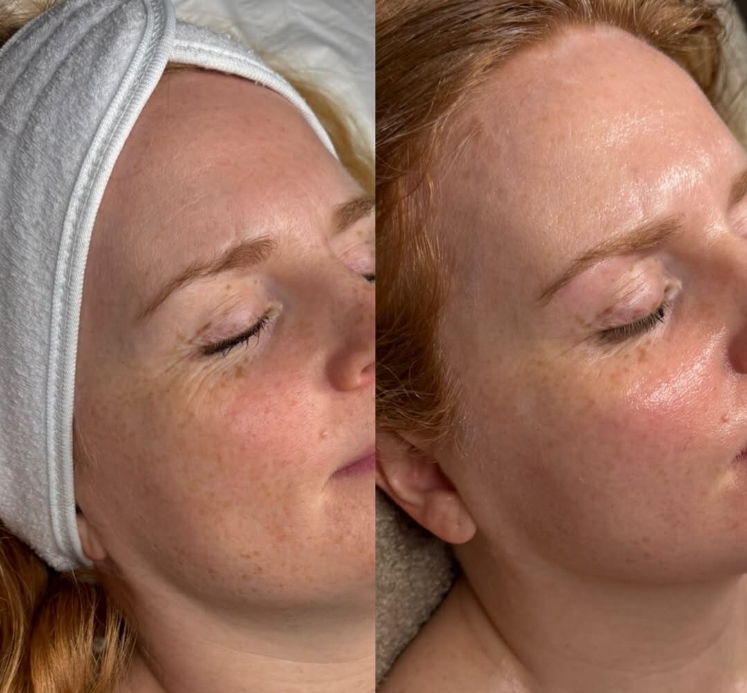 Microneedling using Derma 2.0 Exosomes & Bio - 4 Treatments spaced 4 weeks apart ✨If your wantin (1)