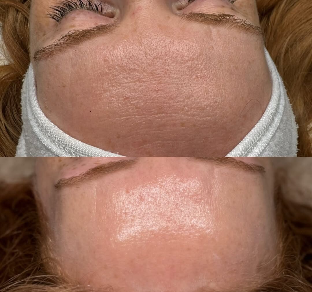 Microneedling using Derma 2.0 Exosomes & Bio - 4 Treatments spaced 4 weeks apart ✨If your wantin (2)