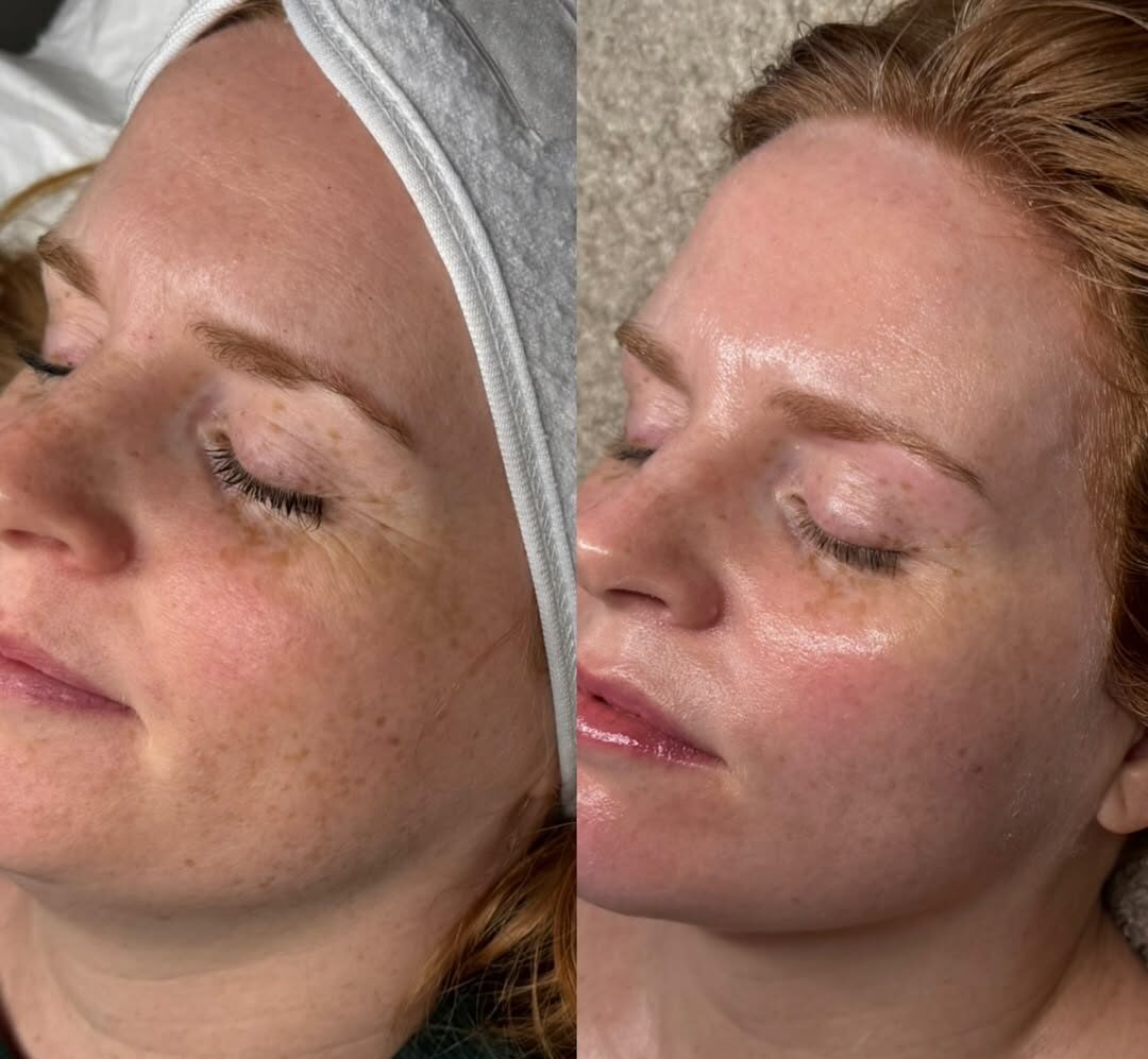 Microneedling using Derma 2.0 Exosomes & Bio - 4 Treatments spaced 4 weeks apart ✨If your wantin